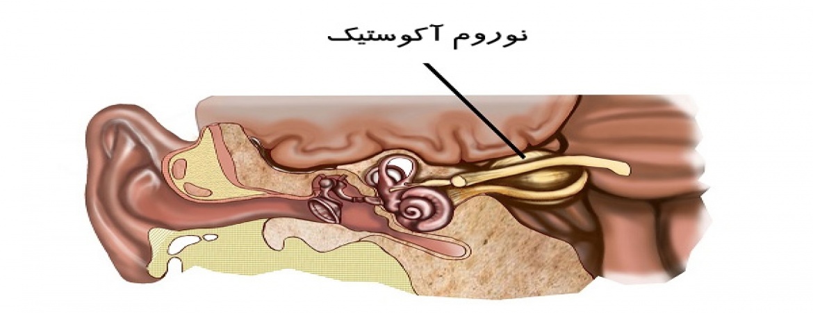 تومور عصب شنوایی یا نوروم آکوستیک