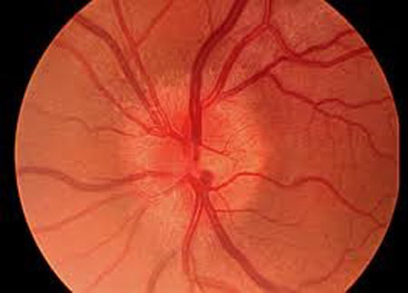 علت التهاب عصب چشم چیست؟
