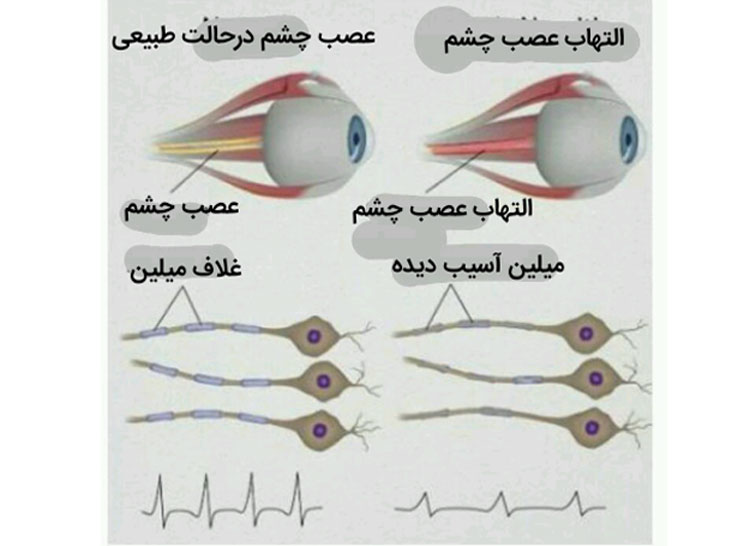 بیماری نوریت اپتیک یا التهاب عصب چشم